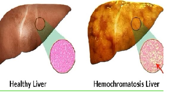 Hemochromatosis