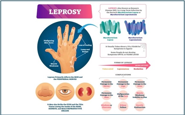 Leprosy