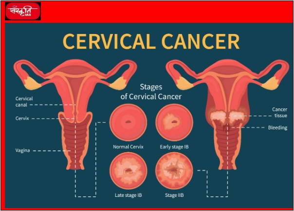 cervical-cancer