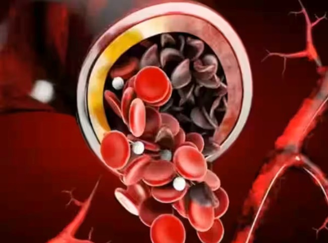 sickle-cell-anemia